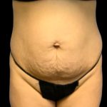 Tummy Tuck Before & After Patient #7232
