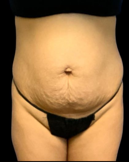 Tummy Tuck Before & After Patient #7232