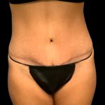 Tummy Tuck Before & After Patient #7232