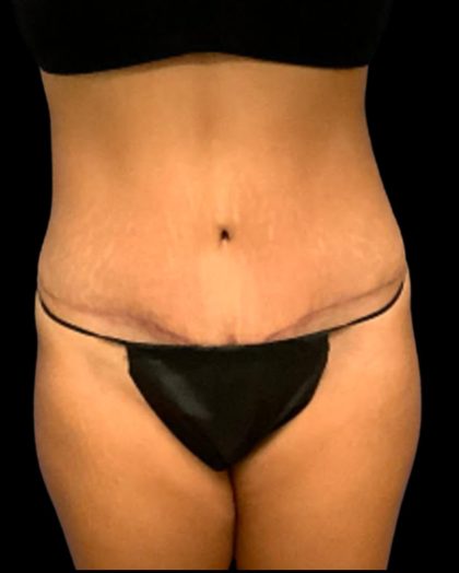 Tummy Tuck Before & After Patient #7232