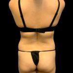 Tummy Tuck Before & After Patient #7232