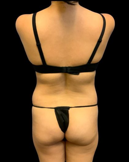 Tummy Tuck Before & After Patient #7232
