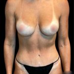 Tummy Tuck Before & After Patient #7233