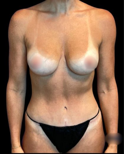 Tummy Tuck Before & After Patient #7233