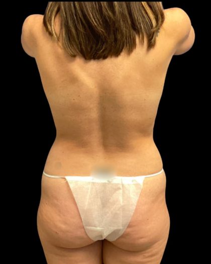 Tummy Tuck Before & After Patient #7233