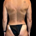 Tummy Tuck Before & After Patient #7233