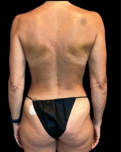 Tummy Tuck Before & After Patient #7233
