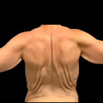 Arm Lift Before & After Patient #7234
