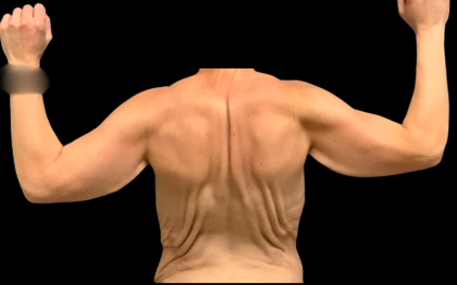 Arm Lift Before & After Patient #7234