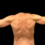 Arm Lift Before & After Patient #7234