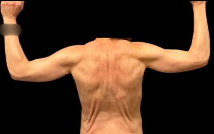 Arm Lift Before & After Patient #7234