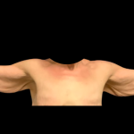 Arm Lift Before & After Patient #7234