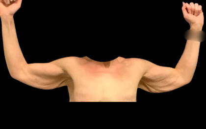 Arm Lift Before & After Patient #7234