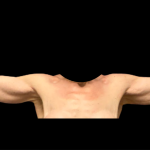 Arm Lift Before & After Patient #7234