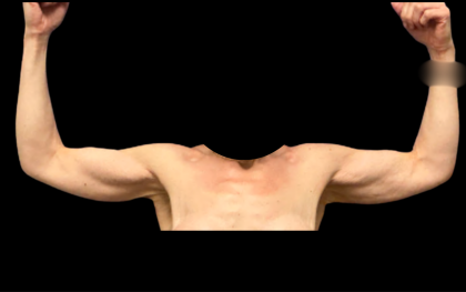 Arm Lift Before & After Patient #7234