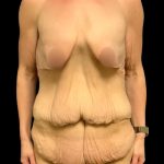Tummy Tuck Before & After Patient #7028