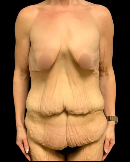 Tummy Tuck Before & After Patient #7028