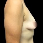 Mastopexy Augmentation Before & After Patient #6974