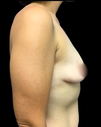 Mastopexy Augmentation Before & After Patient #6974