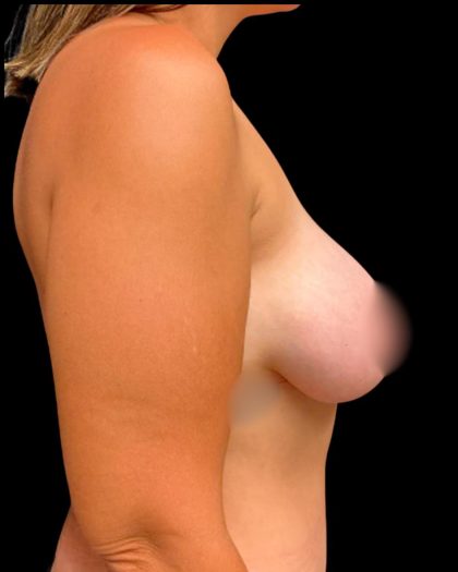 Mastopexy Augmentation Before & After Patient #6974
