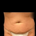Tummy Tuck Before & After Patient #7029