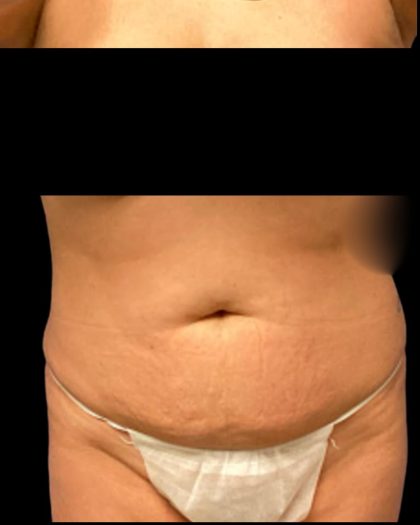 Tummy Tuck Before & After Patient #7029