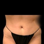 Tummy Tuck Before & After Patient #7029