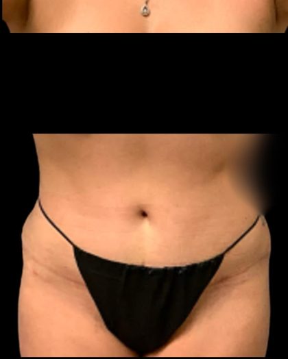 Tummy Tuck Before & After Patient #7029