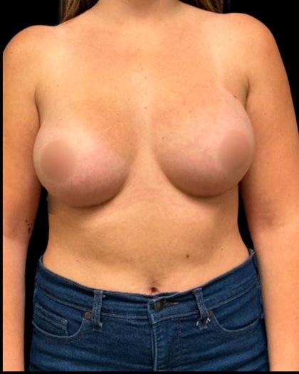 Mastopexy Augmentation Before & After Patient #6975