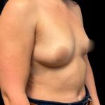 Mastopexy Augmentation Before & After Patient #6975