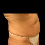 Tummy Tuck Before & After Patient #7029
