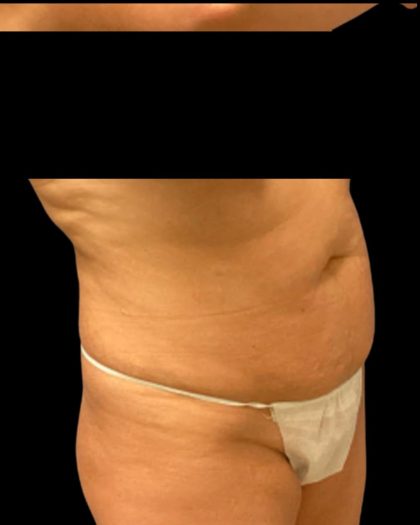 Tummy Tuck Before & After Patient #7029