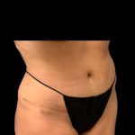 Tummy Tuck Before & After Patient #7029