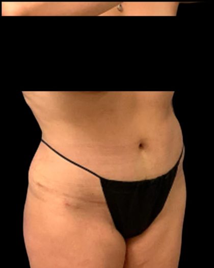 Tummy Tuck Before & After Patient #7029