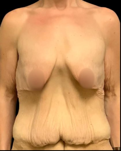 Mastopexy Augmentation Before & After Patient #7030