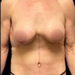 Mastopexy Augmentation Before & After Patient #7030