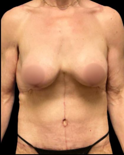 Mastopexy Augmentation Before & After Patient #7030