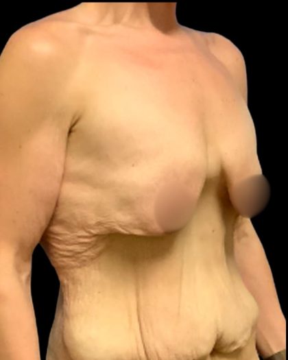 Mastopexy Augmentation Before & After Patient #7030