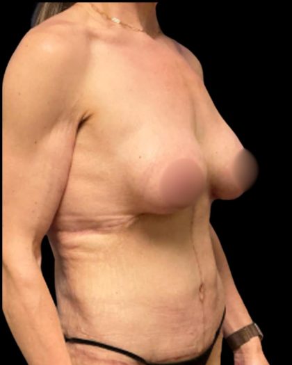 Mastopexy Augmentation Before & After Patient #7030