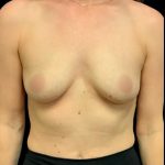 Mastopexy Augmentation Before & After Patient #7031