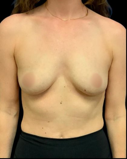 Mastopexy Augmentation Before & After Patient #7031