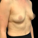 Mastopexy Augmentation Before & After Patient #7031