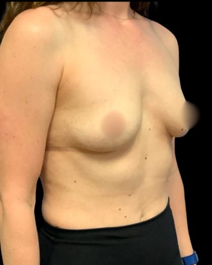 Mastopexy Augmentation Before & After Patient #7031