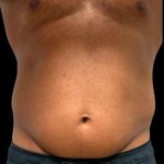 Liposuction Before & After Patient #6978