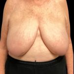 Bilateral Breast Reduction Before & After Patient #7032