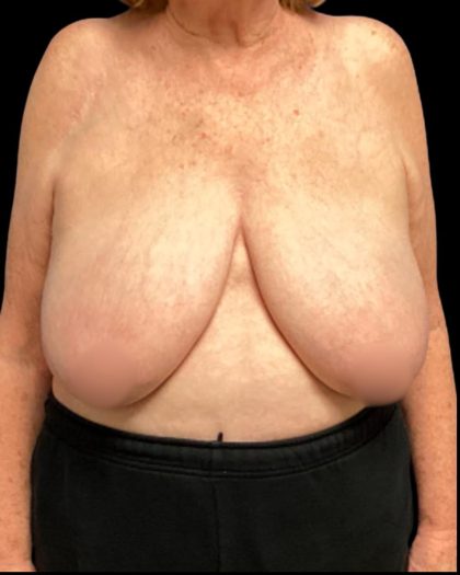 Bilateral Breast Reduction Before & After Patient #7032