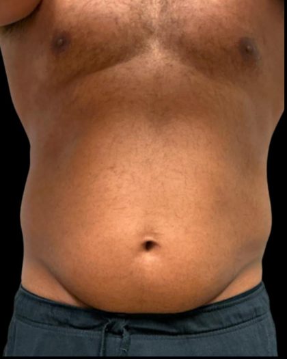 Liposuction Before & After Patient #6978