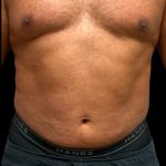 Liposuction Before & After Patient #6978