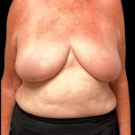 Bilateral Breast Reduction Before & After Patient #7032