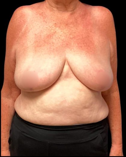 Bilateral Breast Reduction Before & After Patient #7032